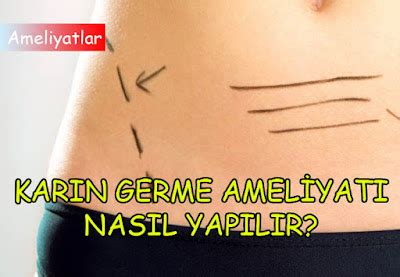 Ameliyatsız Karın Germe Nedir?